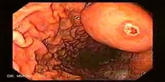 Video Endoscopy of Enormous Gastric Leiomyoma
