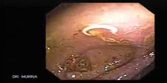 Video Colonoscopy Showing a Parasite in the Cecum