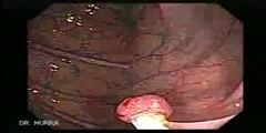 Removal of colon polyp