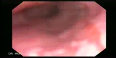 Endoscopia de Esofago de Barrett con magnificacion