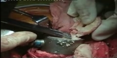 Hip resurfacing surgery -  Vijay C Bose - Part 3