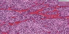 Adrenal--Neuroblastoma tissues