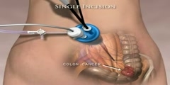 Single Incision Laparoscopic Colectomy utilizing SILS port