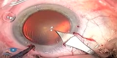 Surgically Induced Astigmatism Phaco 3.1 Complications