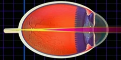 Astigmatism - What Is Astigmatism