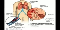 Pulmonary Embolism