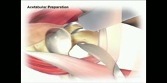 Hip Replacement Acetabulum Preparation