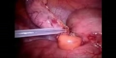 Appendectomy