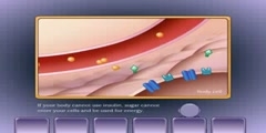 Diabetes Mellitus type 2