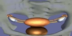 Tubal ligation - Scientific Video and Animation Site Tubal ligation - Scientific Video and Animation Site