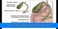 Removal of gallstone by detoxification