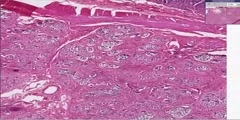 Cystic fibrosis: histopathology of pancreas