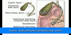 Detoxification for gallstone Removal