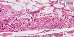 Histopathology Heart, pericardium - Metastatic breast carcinoma