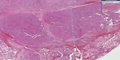 Thyroid - Papillary carcinoma