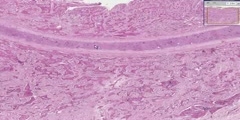 Lung - Squamous cell carcinoma