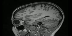 MRI of Brain Relaxation