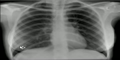 Chest x-ray