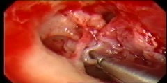 Cholesteatoma Cause of Hearing Loss and Deafness