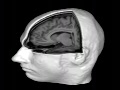 Brain Scan via MRI