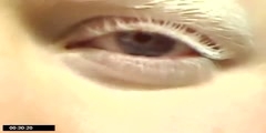 Albinism and the Human Eye