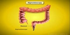 Screening for Colorectal Cancer