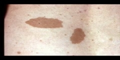 A Project in Neurofibromatosis