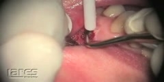 Dental surgery by laser