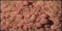 Porter Colley's Neurofibromatosis