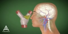 3D animation of Stroke