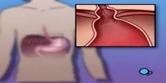 Medical Animation Hiatal Hernia 3D