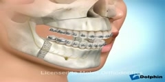 Jaw Reconstruction and dental braces