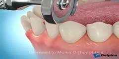 Animation of dental braces installation