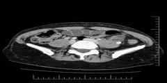 Abdomen CT scan