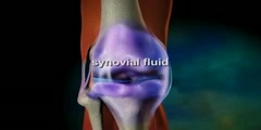 Animation of Osteoarthritis