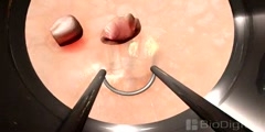 Removing tumor from the bladder with a resectoscope