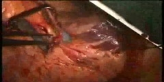Open Heart Surgery,  Arteriotomy