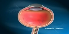 Development of  Glaucoma