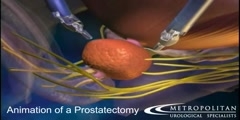 Prostatectomy via the da Vinci Robotic surgery  animation