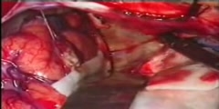 Complete excision of a craniopharyngioma