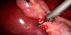 Clipless laparoscopic cholecystectomy