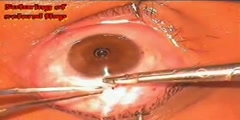 Eye surgery trabeculectomy