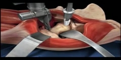 Animation of a total hip replacement