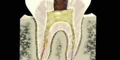 3D Animation of a dental abscess
