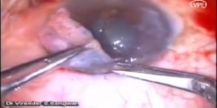 Auto Conjunctival Graft with Pterygium Excision