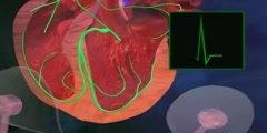 Effects of Atrial Fibrillation