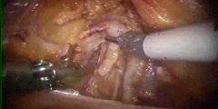 Robotic  Surgery of Prostatectomy