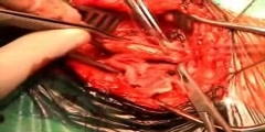 Endarterectomy Surgery of the Carotid