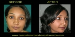 India and Bangalore nose reshaping (Rhinoplasty)