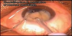 Phacoemulsification of the eye
